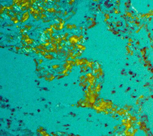 Inne postacie amyloidozy