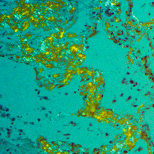 Inne postacie amyloidozy