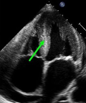 Obraz amyloidozy serca w badaniu echokardiograficznym (zaznaczona pogrubiona przegroda międzykomorowa)