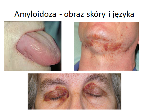 Amyloidoza - obraz skóry i języka