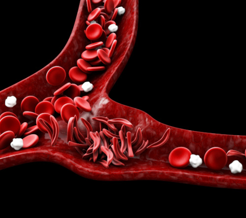 Częstość występowania i czynniki determinujące niedobór żelaza w amyloidozie serca