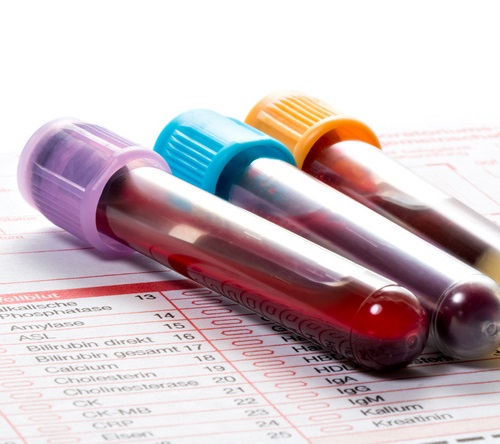 Amyloidoza łańcuchów lekkich i podwyższona liczba krwinek w morfologii krwi obwodowej – polskie badanie retrospektywne