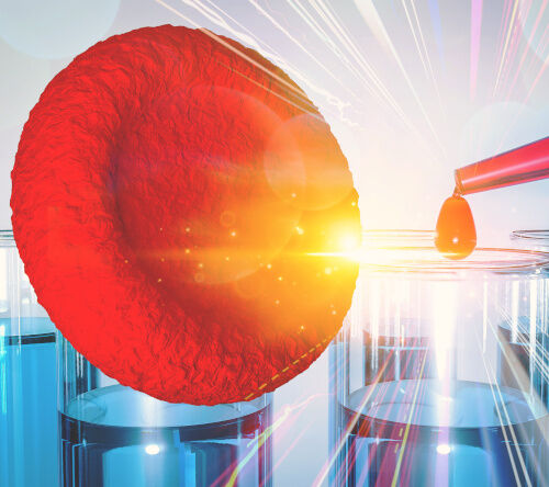 O czym świadczy niedobór czynnika X u pacjentów z amyloidozą łańcuchów lekkich?