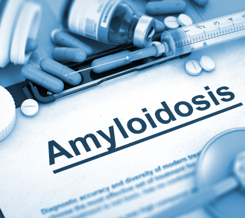Teclistamab w leczeniu amyloidozy łańcuchów lekkich