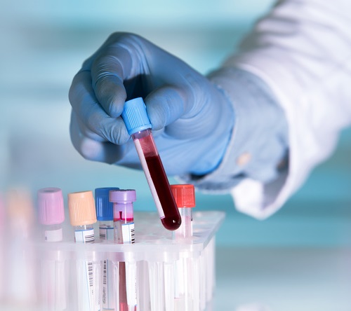 Znaczenie niedoboru żelaza u chorych z zajęciem serca w przebiegu amyloidozy łańcuchów lekkich