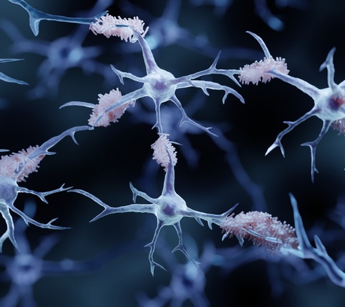 Rola markerów uszkodzenia mięśnia sercowego w diagnostyce amyloidozy serca