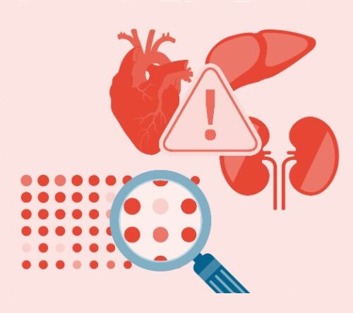 Czym jest amyloidoza łańcuchów lekkich?