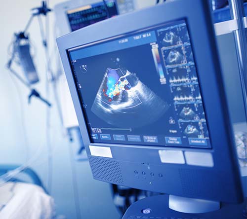 Analiza czynników wpływających na rokowanie chorych z kardiomiopatią o profilu restrykcyjnym