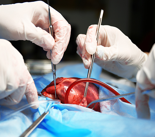 Jakie są obecnie wyniki transplantacji serca u pacjentów z amyloidozą z zajęciem tego narządu?